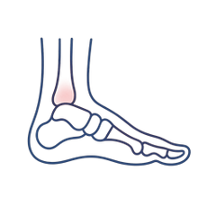 Arthritis