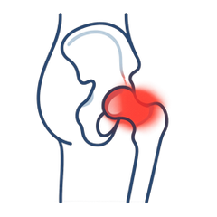 Hip Pain
