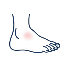 Swollen Feet