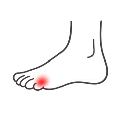 Neuropathy
