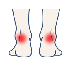 Overpronation