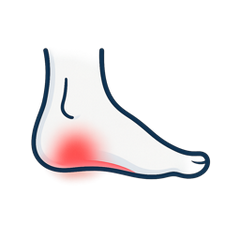 Plantar Fasciitis